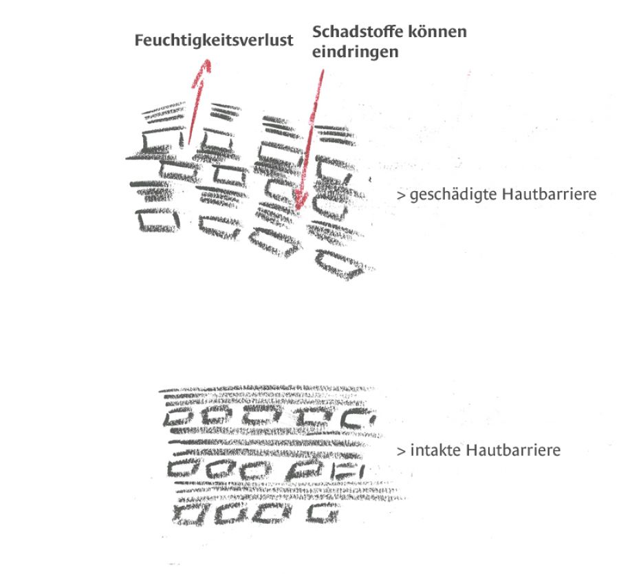 gestörte Hautbarriere bei Rosazea